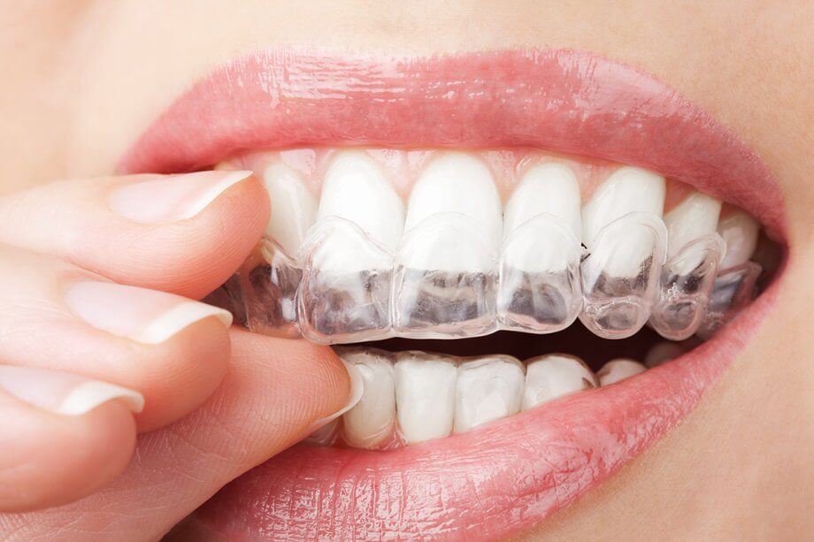 Top Questions to Ask Your Invisalign Provider