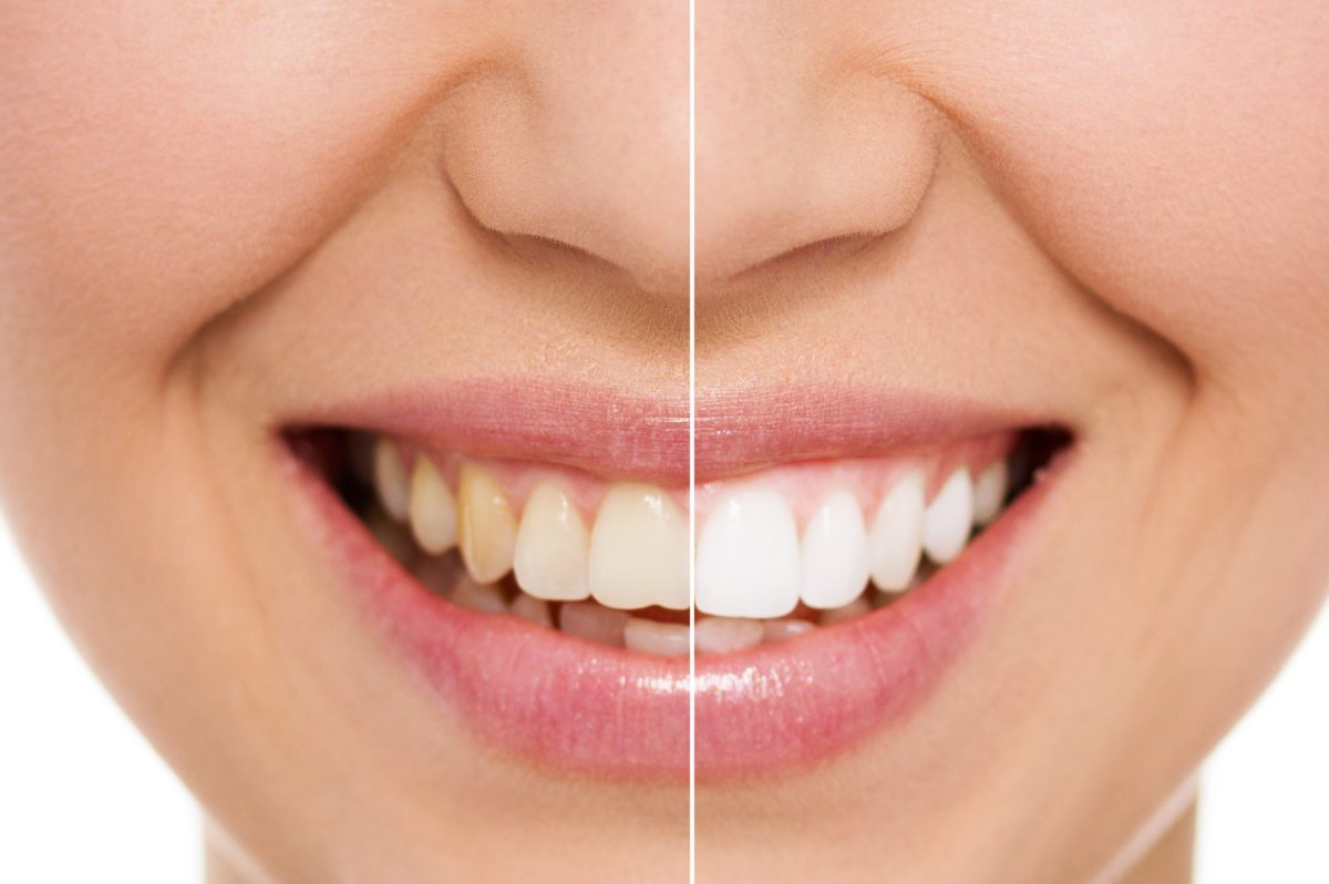 How to Get the Best Results from Teeth Whitening Services